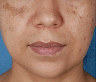 Melasma Treatment - Five Home Remedies That Work Melasma Treatment - Five Home Remedies That Work
