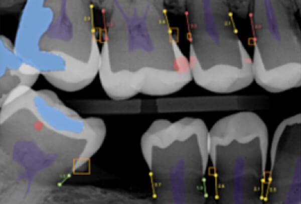 Overjet AI Teeth Scan