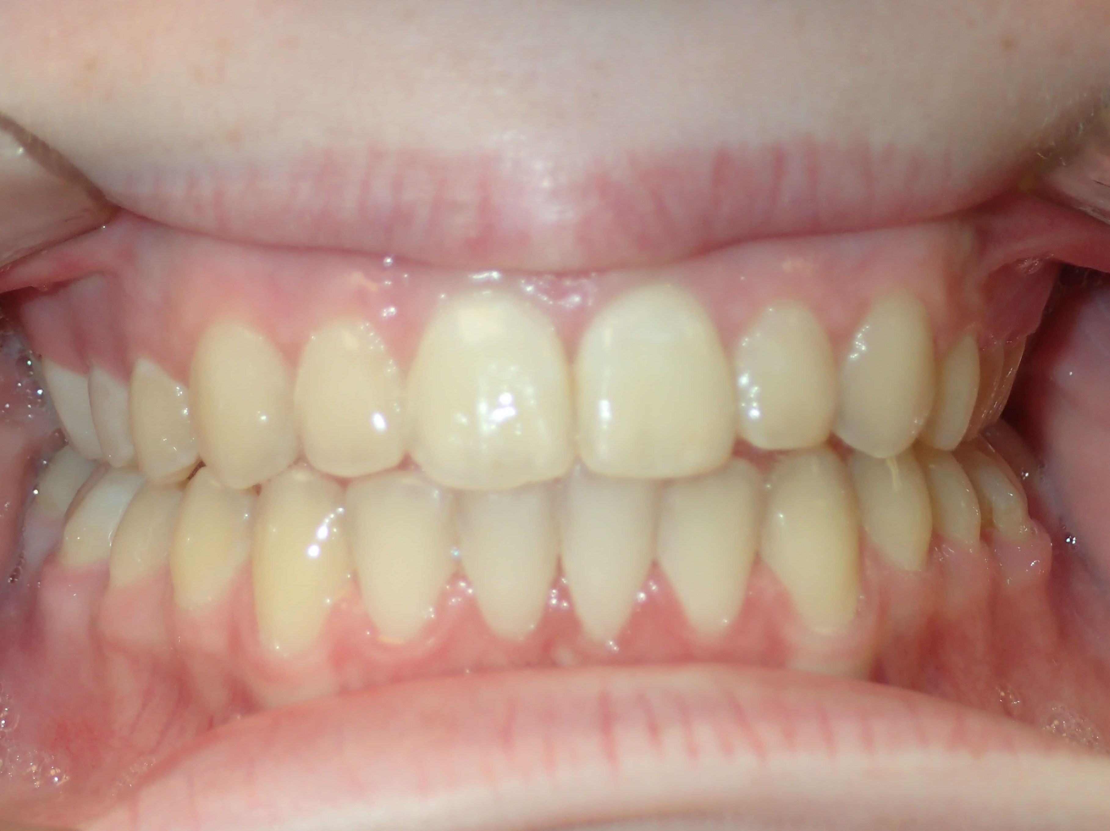 Overbite Distance Spacing with Deep Overbite