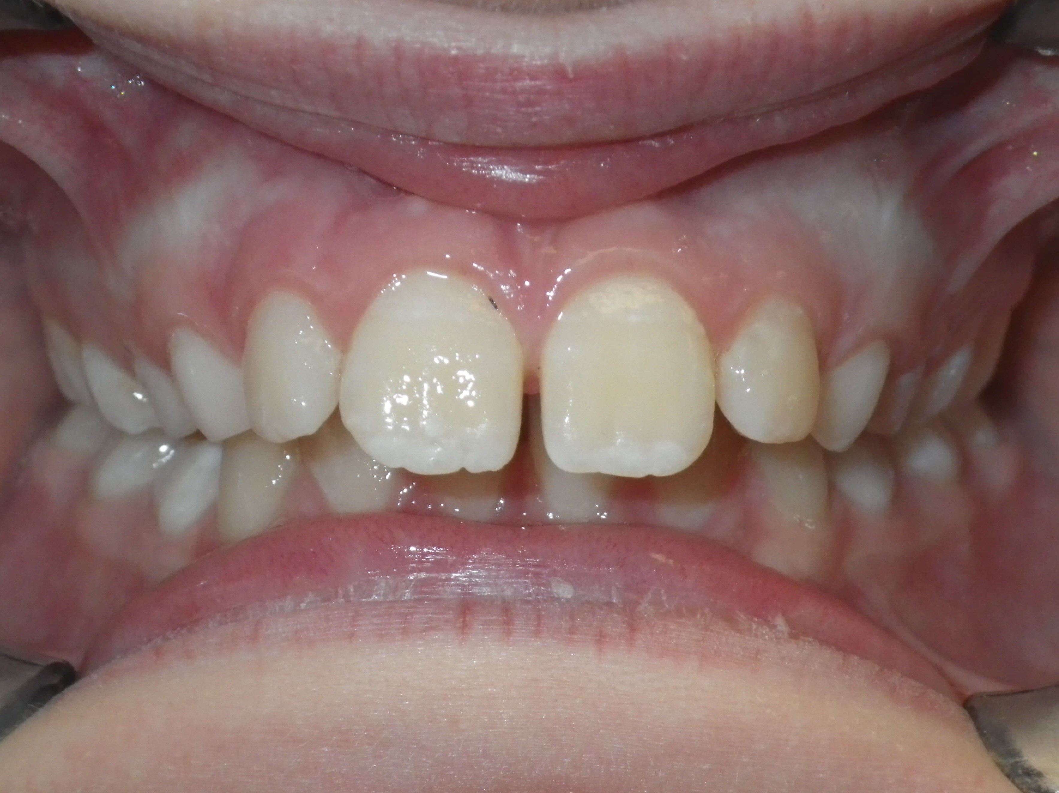 Overbite Distance Spacing with Deep Overbite