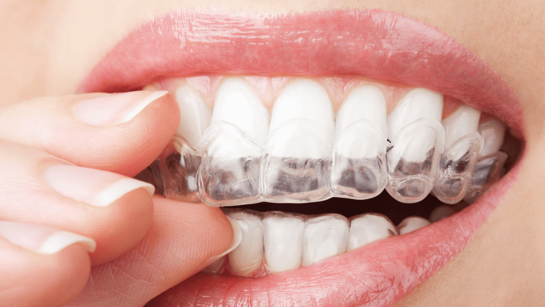 Do Metal Braces Straighten Teeth Faster Than Invisalign® Aligners?