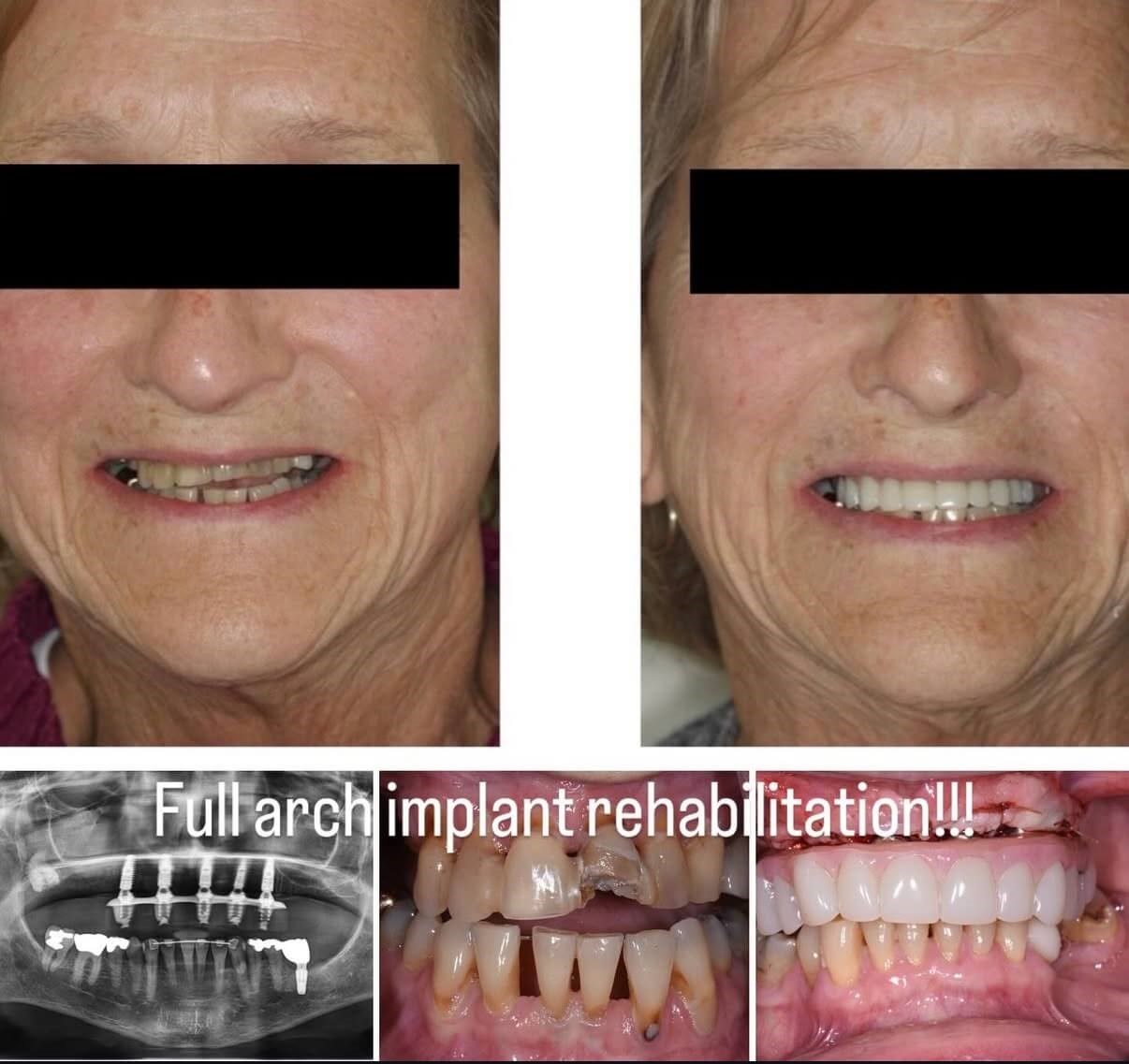 Hybrid Implant Options