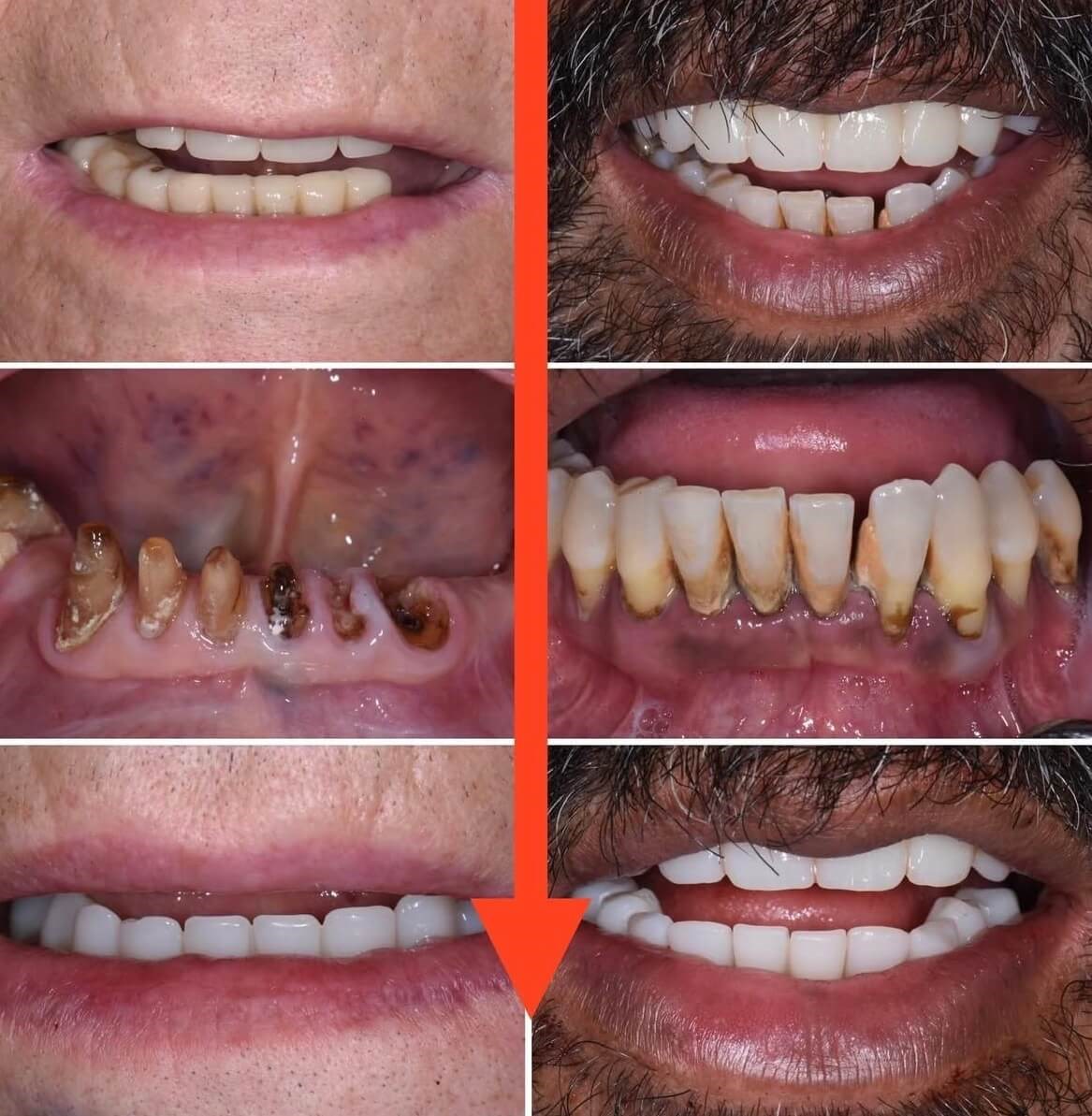 Why Patients Choose Hybrid Restorations