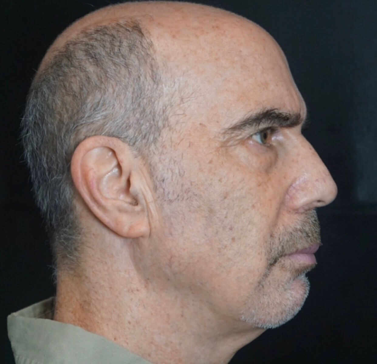 Before and After Microneedling & Morpheus8 Photos