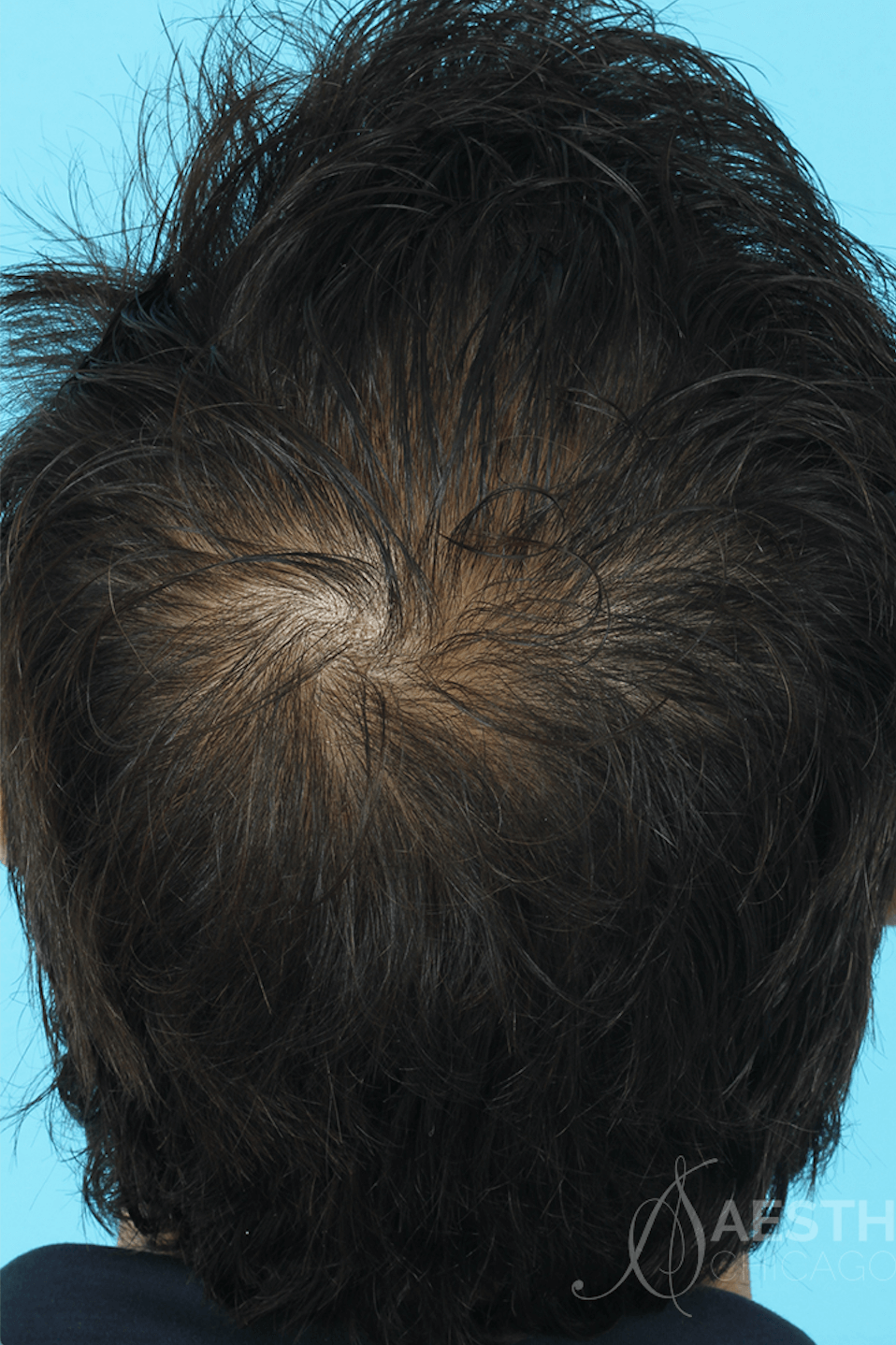 Before and After PRP Therapy for Hair Loss & Genetic Hair ...