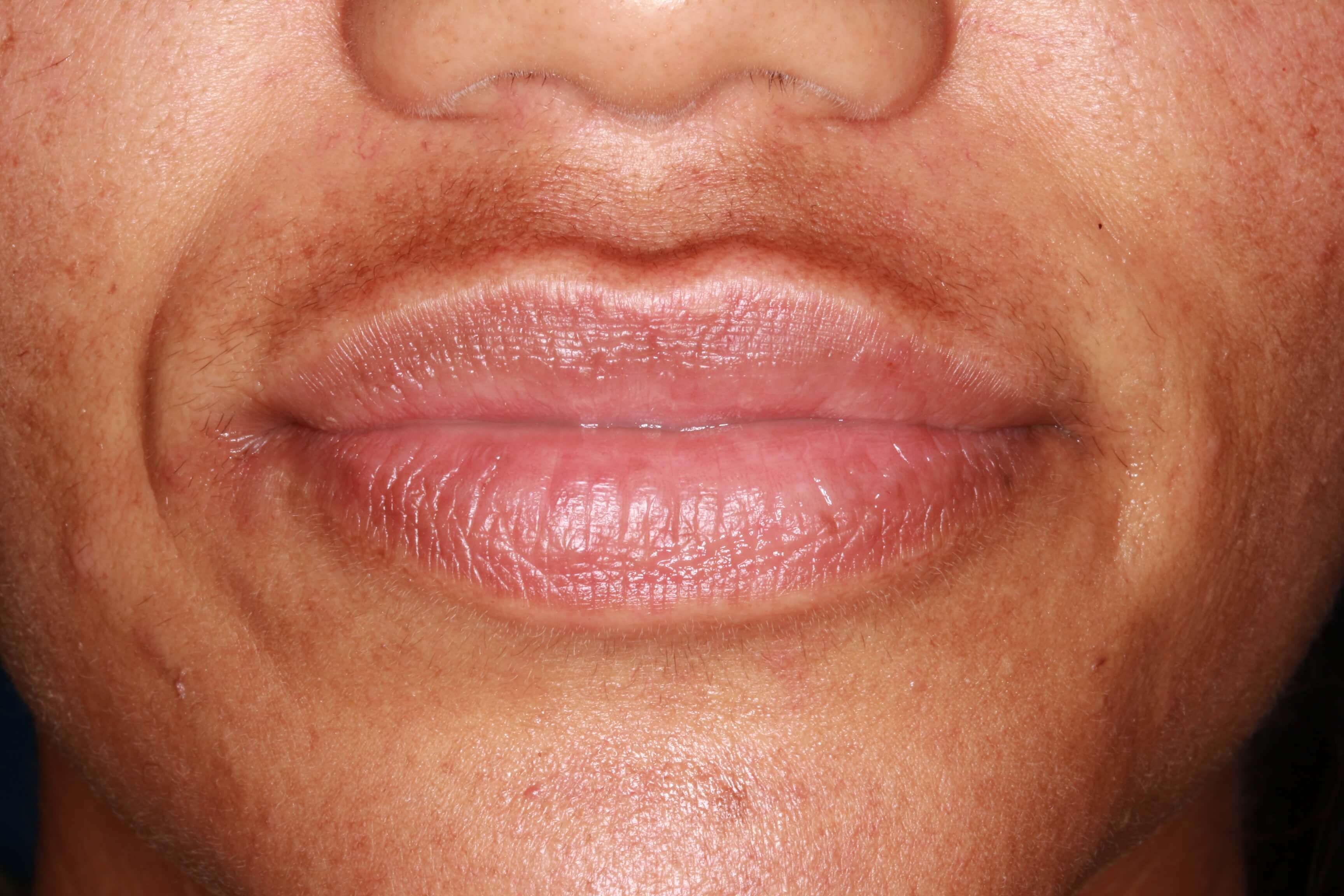 Female Patient with Uneven Lips and Lines