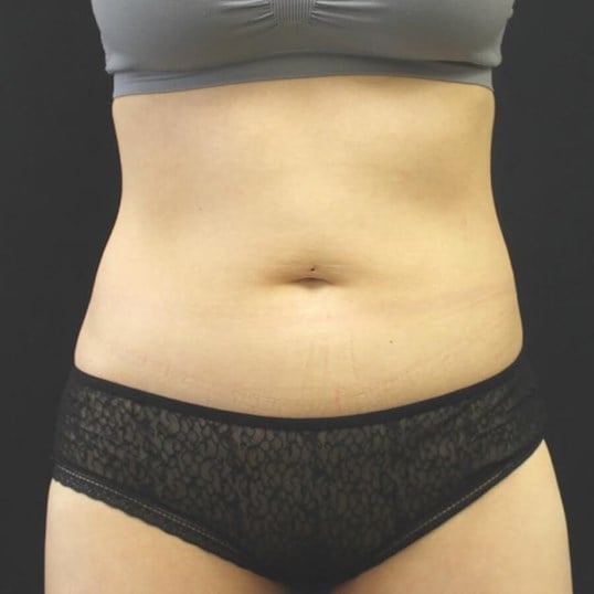 Before Coolsculpting Abdomen Flanks After