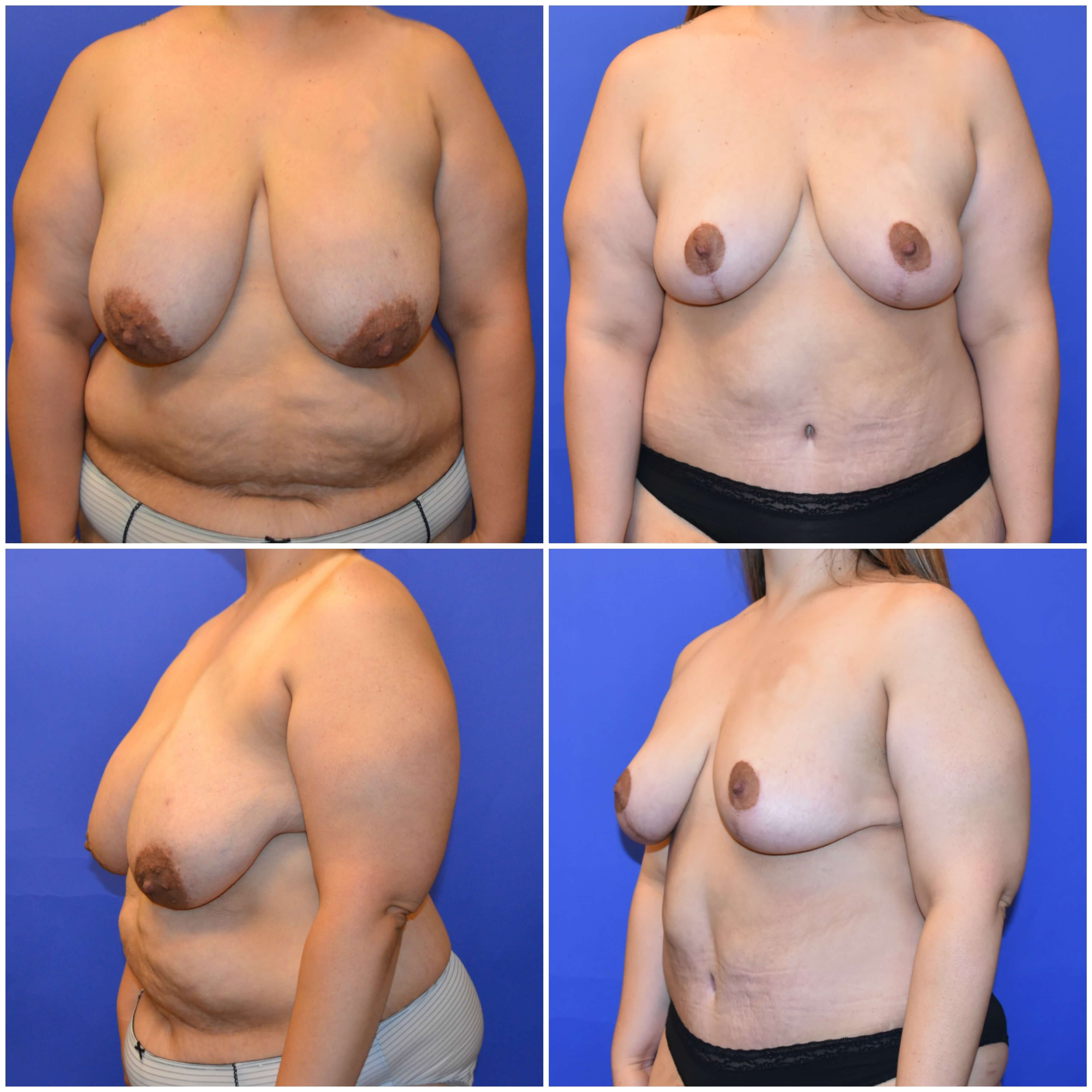 breast-reduction-before-and-after-pics