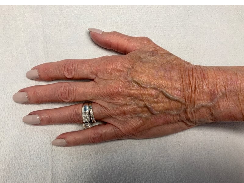 Hand After