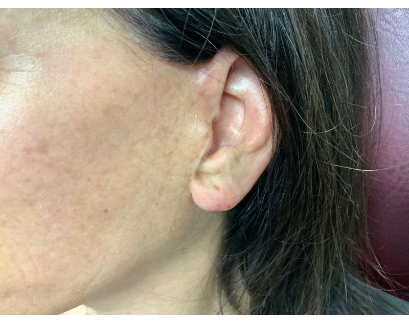 EARLOBE After