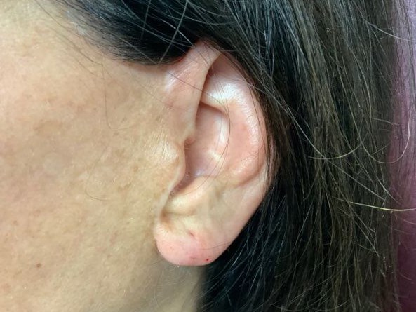 EARLOBE After