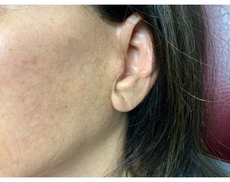EARLOBE Before