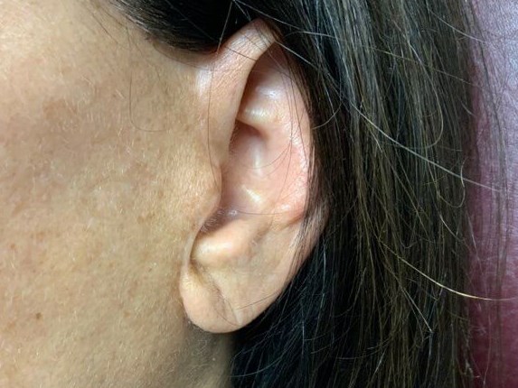 EARLOBE Before
