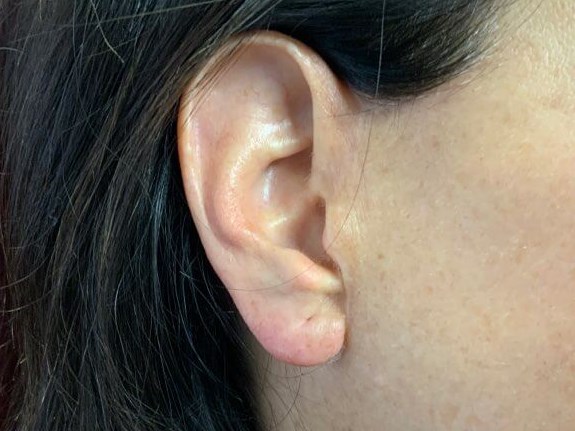 EARLOBE After