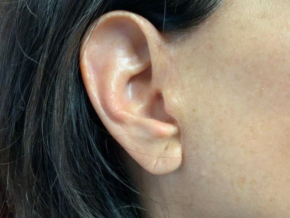 EARLOBE Before