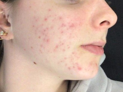 right cheek Before