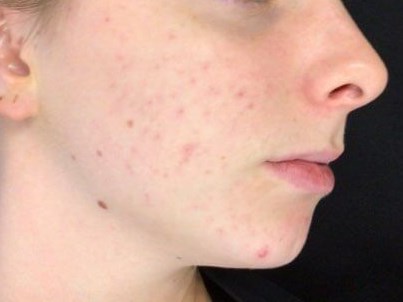 right cheek After