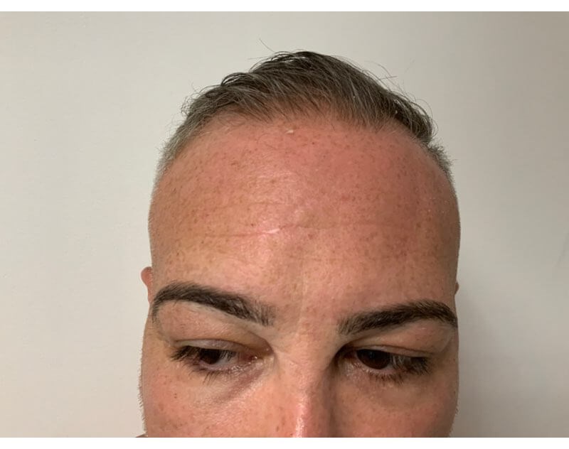 forehead After