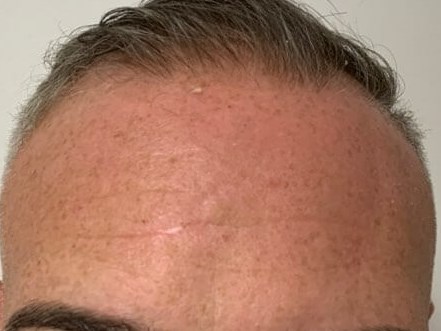 forehead After