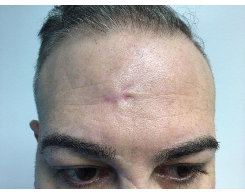forehead Before