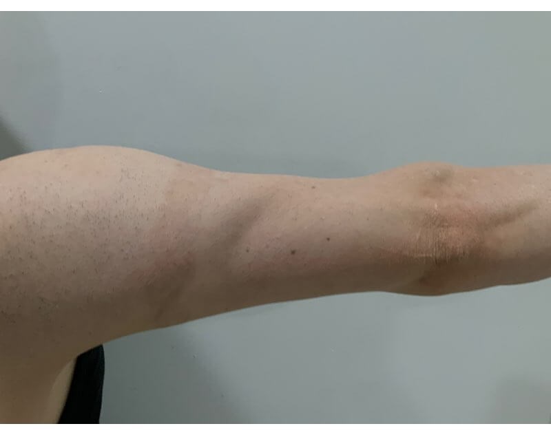 Arm back After