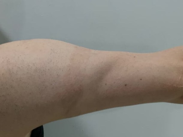 Arm back After