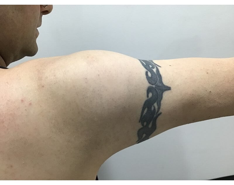 Arm back Before