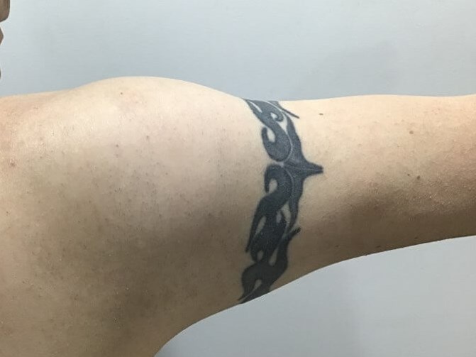 Arm back Before