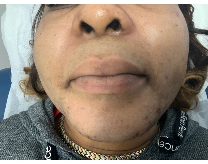LIP After