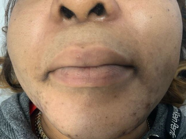 LIP After