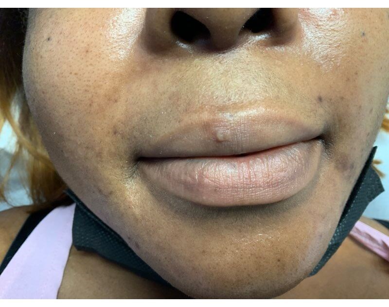 LIP Before