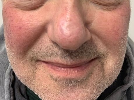 nose scar from MOHS sugery After
