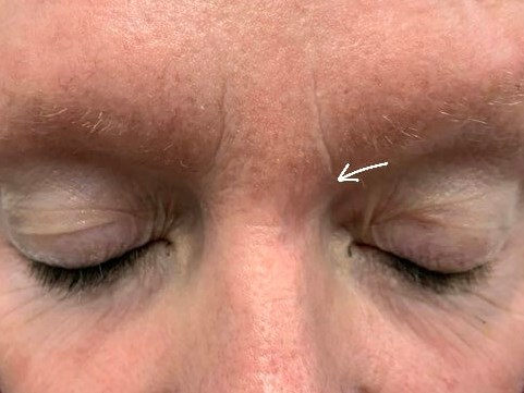 glabella After