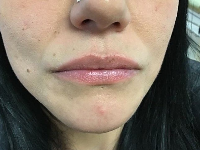 Lip Filler Before
