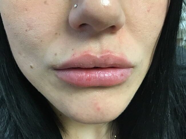 Lip Filler After