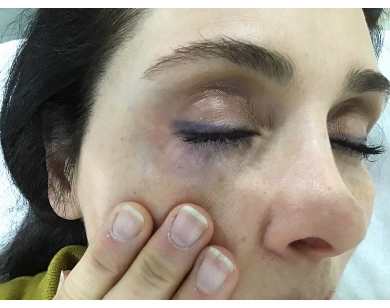 Under Eye Blue Vein After