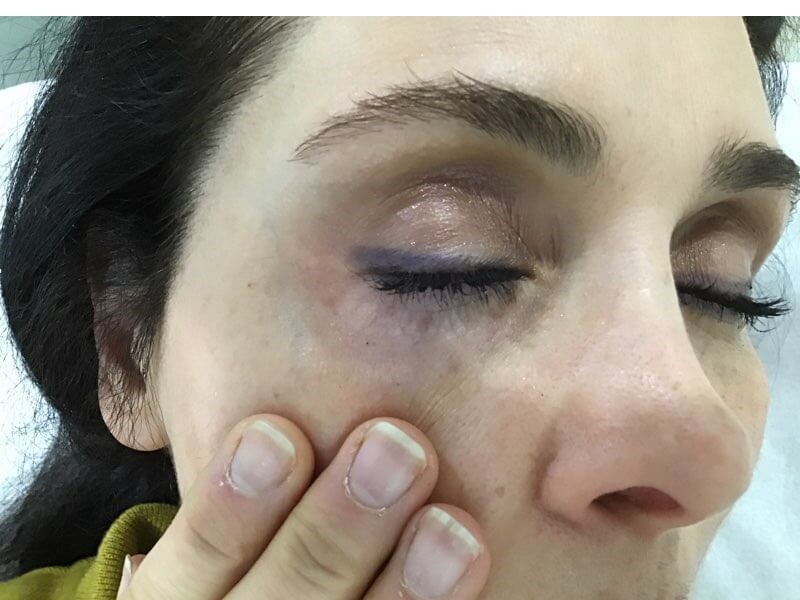 Under Eye Blue Vein After