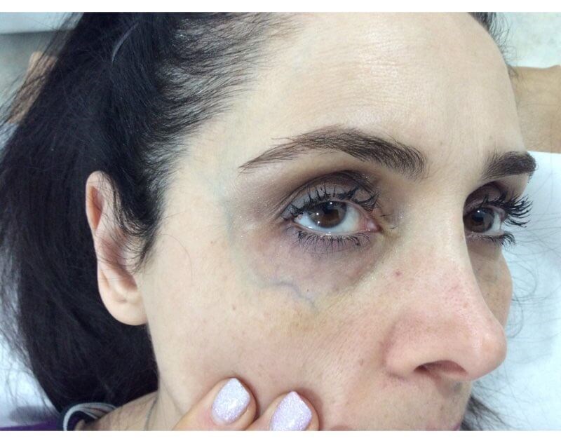 Under Eye Blue Vein Before