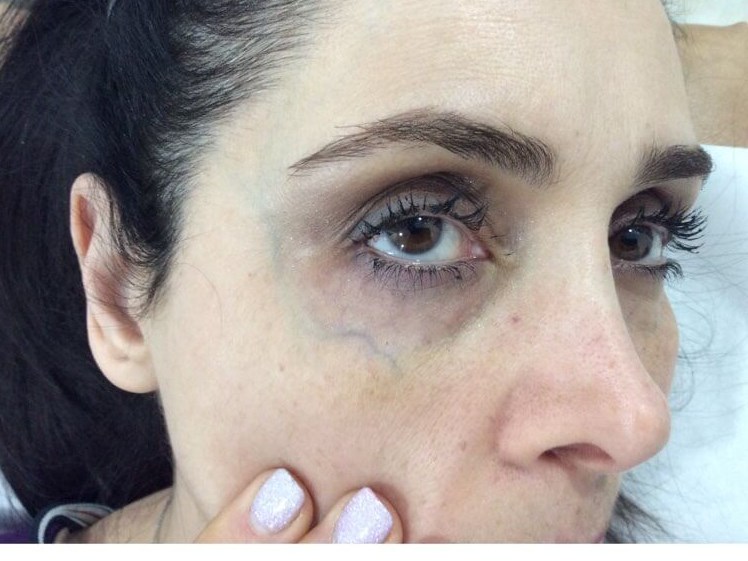 Under Eye Blue Vein Before