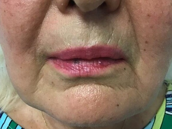 Around Lips After