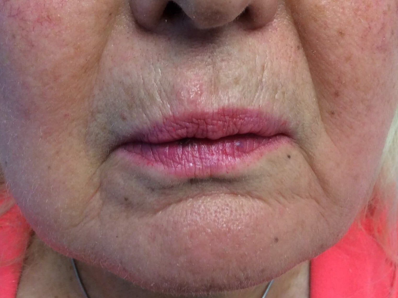 Around Lips Before