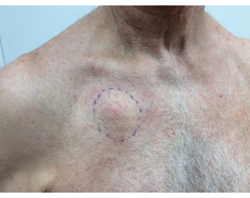 Chest Angle View Before