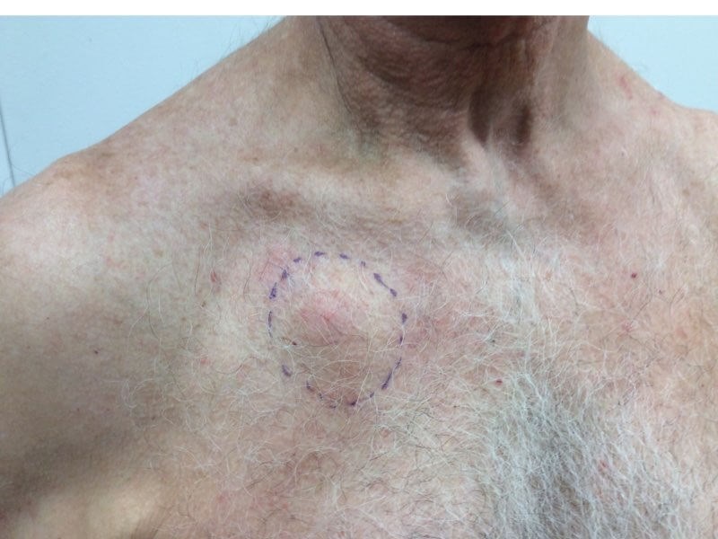 Chest Angle View Before