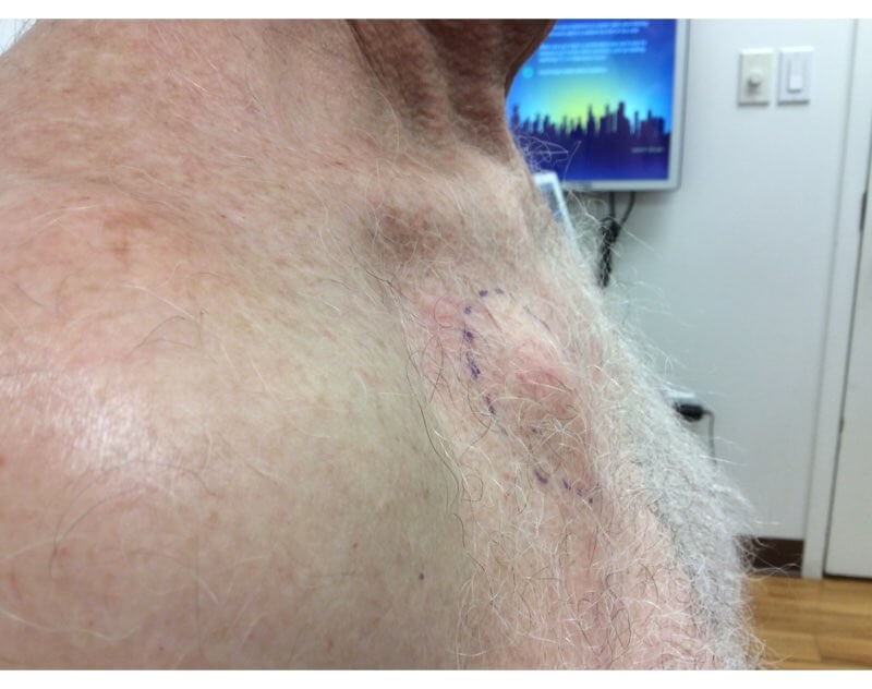 Chest Side View Before