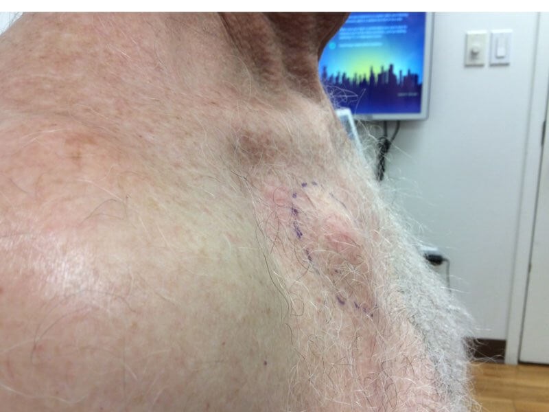 Chest Side View Before