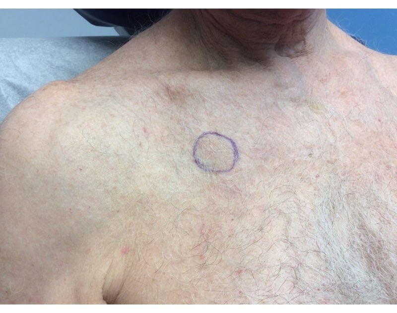 Chest Angle View After