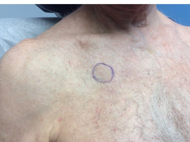 Chest Angle View After