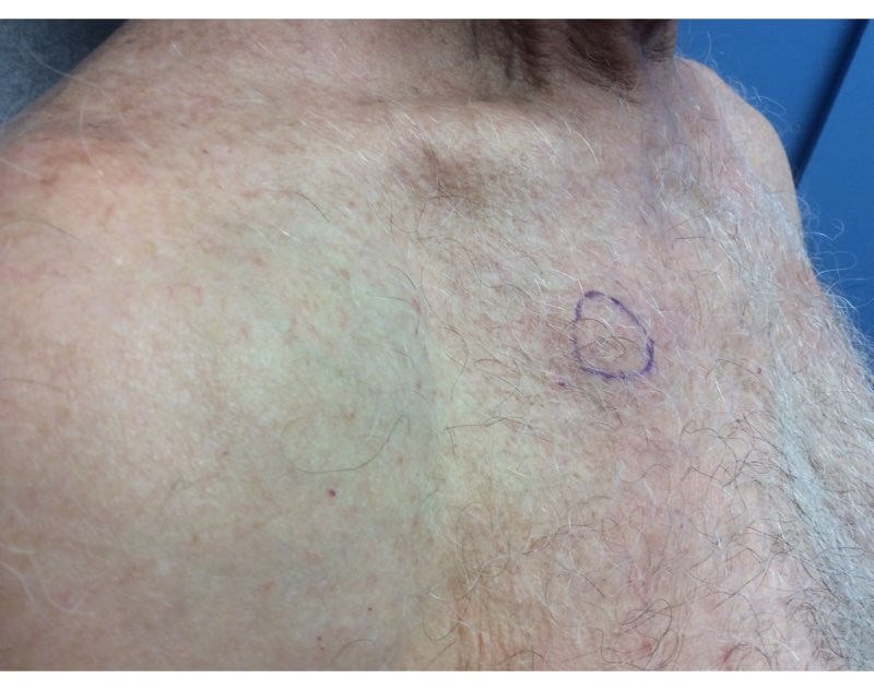 Chest Side View After