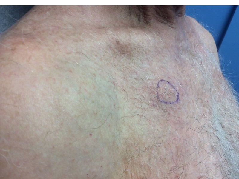 Chest Side View After