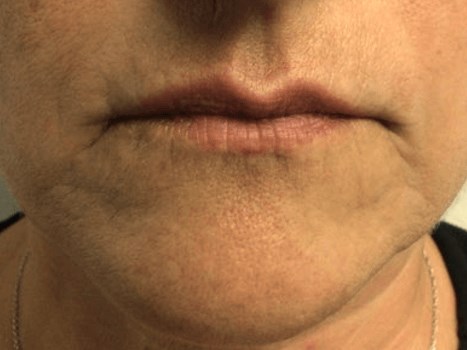 Lips Before